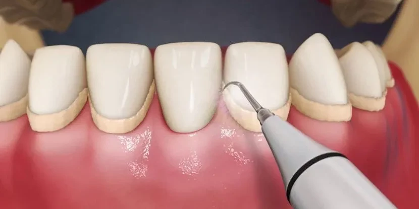 Diş taşının temizlenmemesi diş kaybına yol açabiliyor 