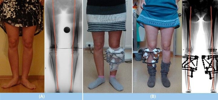 Bacak Damarlarında Kullanılan Stentler Uzuv Kaybını Önleyebiliyor