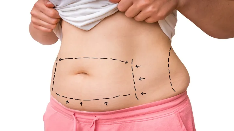 Liposuction ile Bölgesel Fazlalıklara Veda